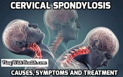 Cervical Spondylosis Causes Symptoms And Treatment Natural Health
