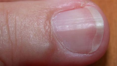 Awasome White Vertical Lines On Big Toe Nails Pics Jonathansamplecomics
