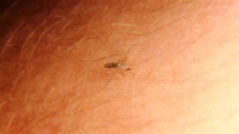 Gnat Bites Symptoms And Causes