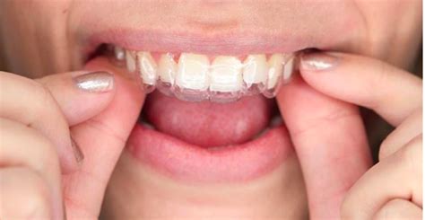 And what makes a bracket worthy of being in your project specifically? Illusions or reality of do it yourself DIY invisible braces named clear aligners — straighten ...