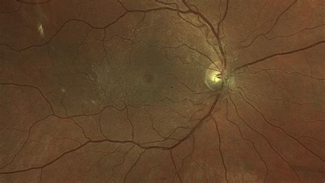 Sonoran Desert Eye Center Macular Hole