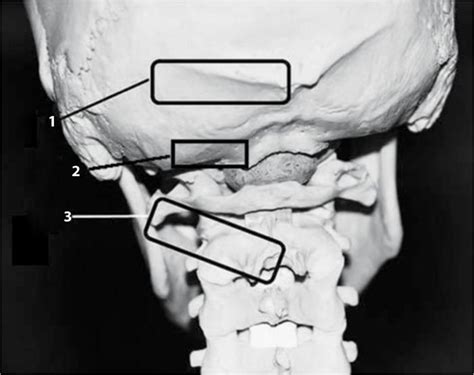 Occipital Nerve Blocks Anesthesia Key