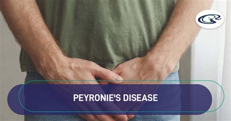 Peyronies Disease Urology Hospital