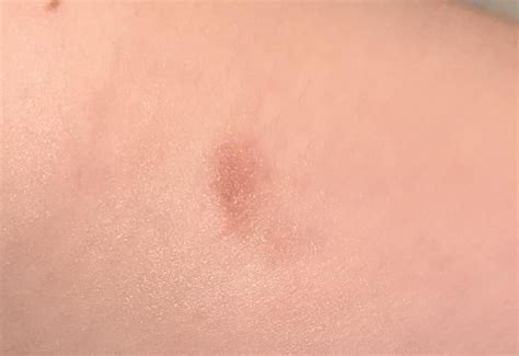 Dry Patch On Skin What Could This Be Rdermatology