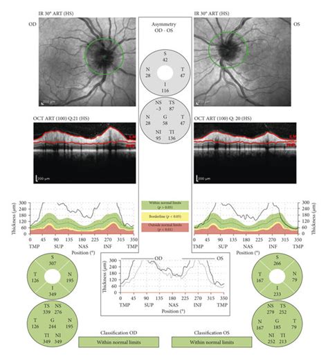 Optic Nerve Head Optical Coherence Tomography Showing Significant Optic
