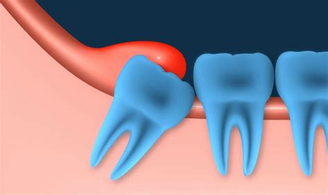 Pericoronitis Gum Infection Associated With Wisdom Teeth D4dentist
