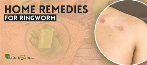 8 Diy Home Remedies For Ringworm Treatment That Work