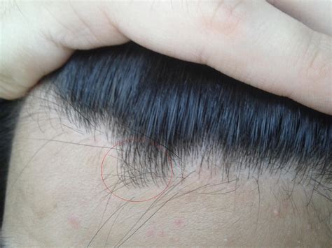 What Is Considered A Normal Hairline? | Zinsel By Imzo