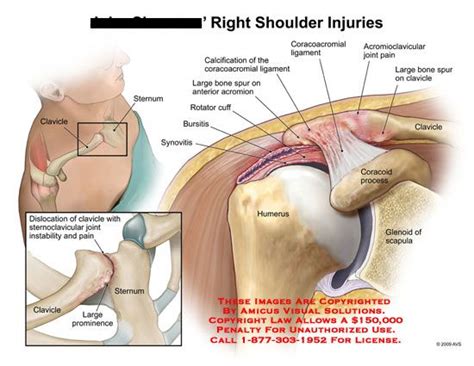 The left shoulder and acromioclavicular joints, and. coracoacromial ligament এর ছবি ফলাফল | Shoulder injuries, Bursitis, Shoulder joint