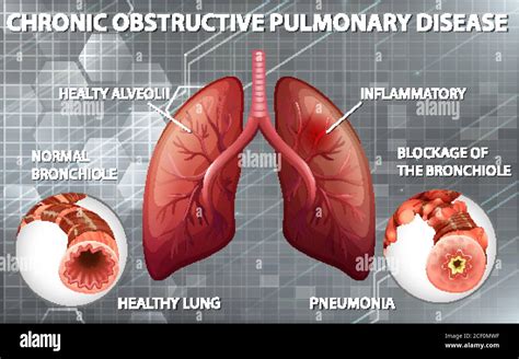 Chronic Obstructive Pulmonary Disease Illustration Stock Vector Image