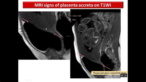 Placenta Lesions Imaging Placenta Placenta Accreta Mri