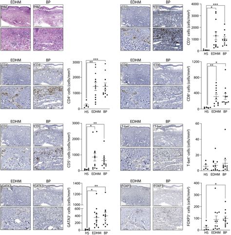 Overexpression Of Helper T Cell Type 2 Related Molecules In The Skin Of