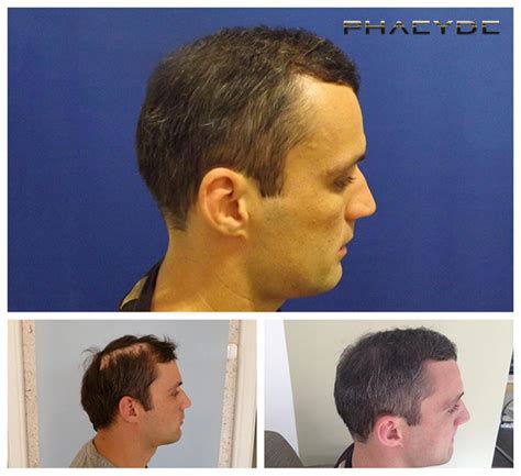 Details More Than Hair Transplant Before And After In Eteachers