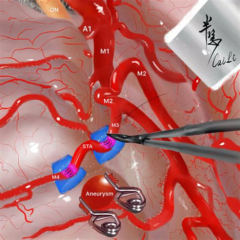 Illustrative Case Of S1 Aneurysm Treatment Intraoperative Picture A