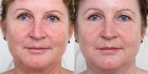 Ipl For Pigmentation Before And After