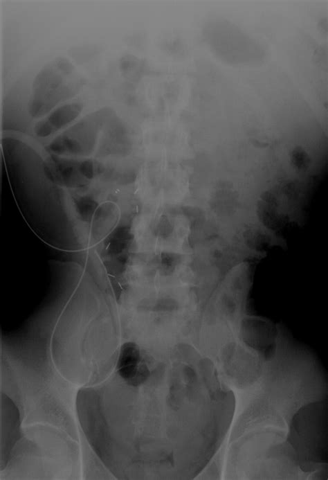Complications Of Continuous Ambulatory Peritoneal Dialysis Radiographics