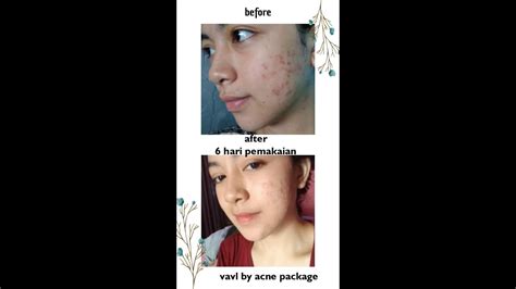 Jerawat merupakan musuh utama untuk wajah. Skincare penghilng bekas jerawat 100%(bpom ) Cara ...