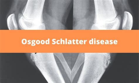 Osgood Schlatters Disease Osd Medical Junction
