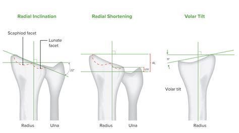 Distal Radius Fractures Concise Medical Knowledge