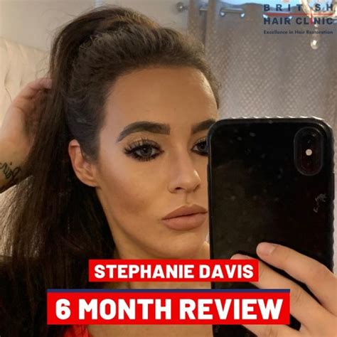 Hollyoaks Star Stephanie Davis Shows Off Results Of Hair Transplant