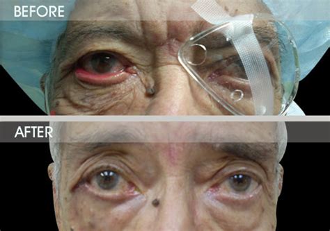 Ectropion Before And After Turned Out Eyelid Repair