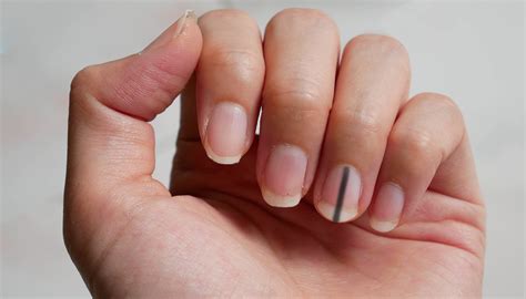 Brown vertical stripe on the nail this may be a sign of melanoma. Melanoma Under Nail Bed Photos - Nail Ftempo