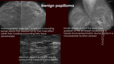 Breast Duct Ectasia Us Mammogram Mri