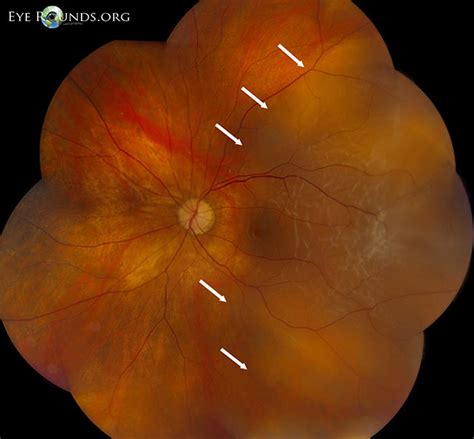 Sep 18, 2019 · floaters (shapes that appear to be floating in the field of vision), blurred vision, dark areas of vision, reduced visual acuity or blindness in severe cases, distorted vision, impaired color vision, or; Vitreous Syneresis: An Impending Posterior Vitreous ...