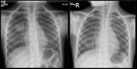 Radiology Signs • Quiz Child With A Cough Initial Chest Xray Is On