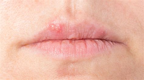 Herpes An Den Lippen Richtig Behandeln Ndrde Ratgeber Gesundheit