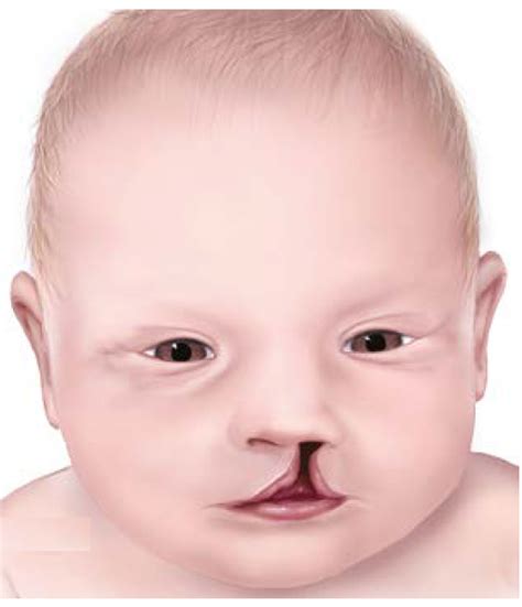 Facts About Cleft Lip And Cleft Palate Cdc 6048 Hot Sex Picture
