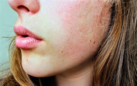 The Best Solution For Acne Eczema And Dry Skin All Perfect Stories