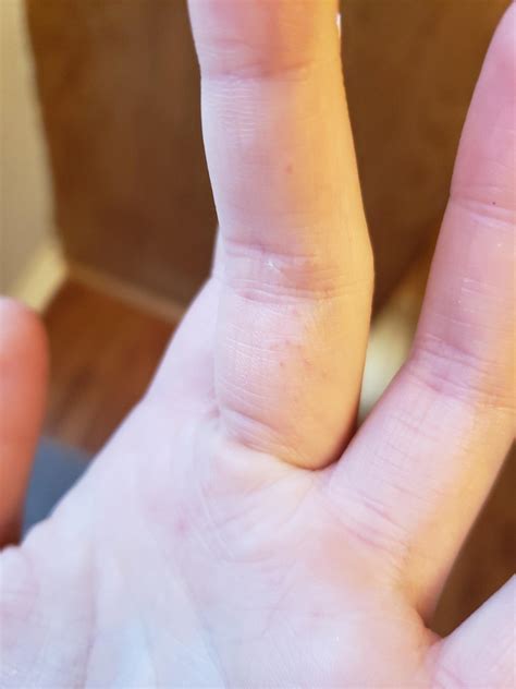 I Get These Small Incredibly Itchy Small Bumps On Two Of My Fingers