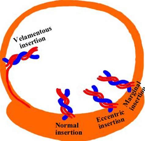 Velamentous Cord Insertion Causes Risks Diagnosis And Delivery