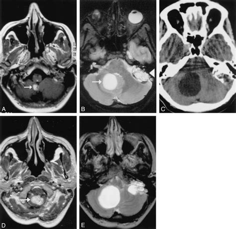 Images In A Patient With A Solid Cerebellar Tumor That Progressed To