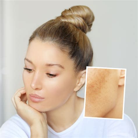 Goodbye To Uneven Skin Pigmentation Beautique Medical Spa