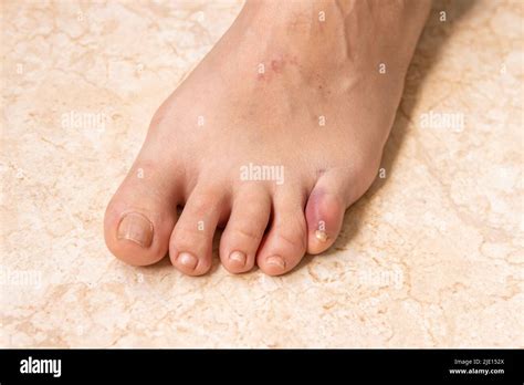 Broken Big Toe Purple Hi Res Stock Photography And Images Alamy