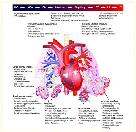 Cardiopulmonary Pathophysiology And Interactions In Patients With Heart