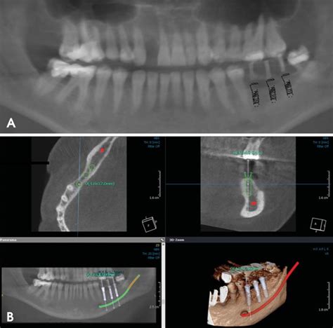 The Implant Planning Process Is Performed Using Panoramic Radiography