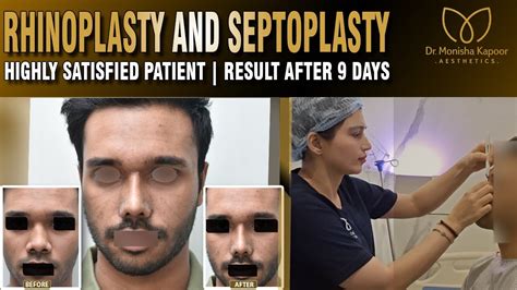 Rhinoplasty Surgeon In Delhi Nose Job In Delhi By Dr Monisha Kapoor Youtube