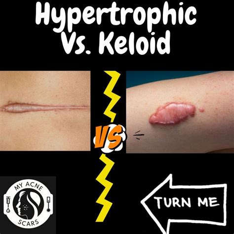 Hypertrophic Vs Keloid Scarring My Acne Scars