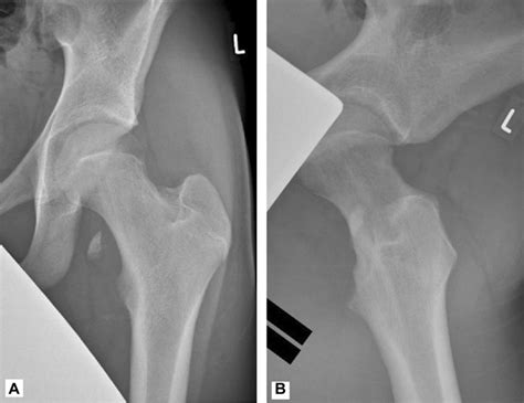 A B Preoperative Ap And Axial Hip Radiographs Of Case 1 Lesser