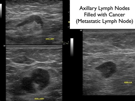 Armpit Ultrasound Images