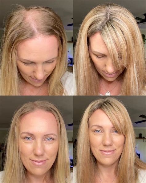 Aggregate More Than Hairstyles For Balding Hair Female Latest