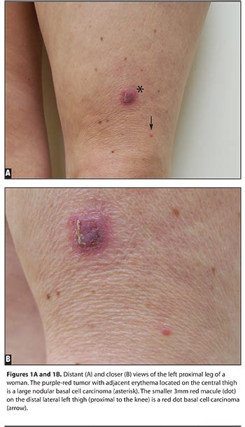 Anexar Ás Picar Basal Cell Carcinoma On Leg Escreva étnico Carga