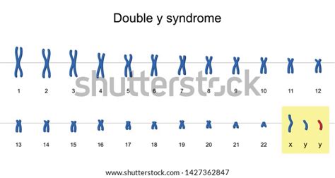 Double Y Syndrome Karyotype Nondisjunction Of Sex Chromosomes Xyy