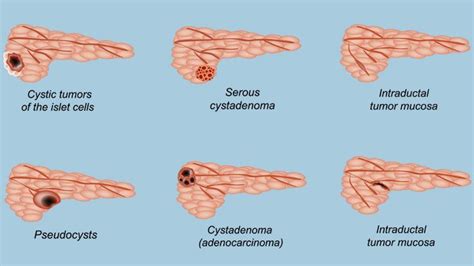 What Is A Pancreatic Cyst Everyday Health