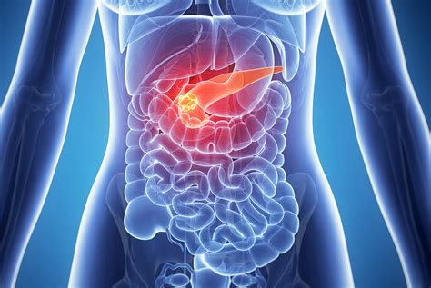 Pancreatic cancer often goes undetected until it's advanced and difficult to treat. Targeting Pancreatic Cancer with a New Therapy - Boston ...