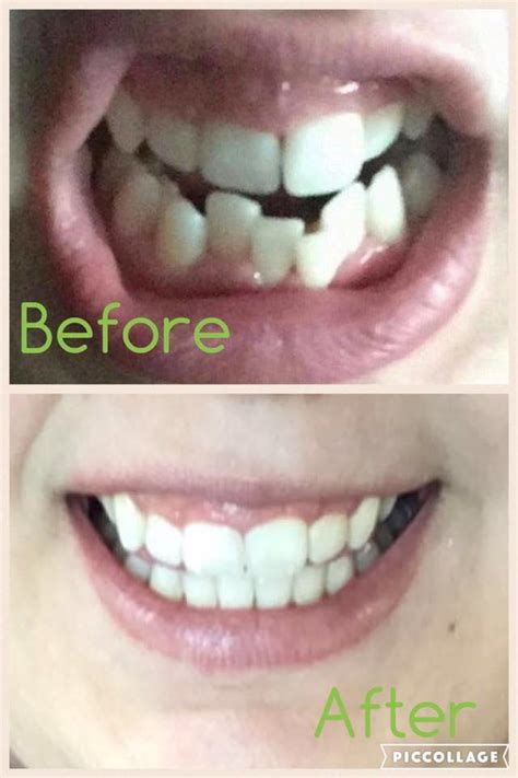 Invisalign Crooked Teeth Before And After Teeth Poster