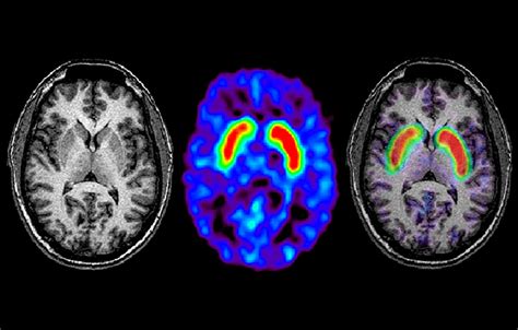 Mri In Parkinson Disease Expanding Usability For Better